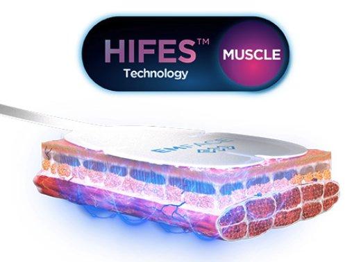 전기 자극(HIFES) 기술이 얼굴 근육층에 작용하는 원리를 보여주는 기술 도식